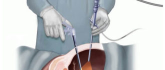 ЭКО, эндометриоз, лапароскопия