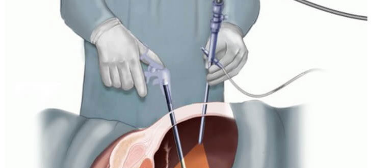 ЭКО, эндометриоз, лапароскопия