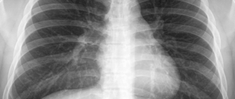Метастаз нет при флюрографии