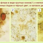 Чистка после фармацевтического аборта