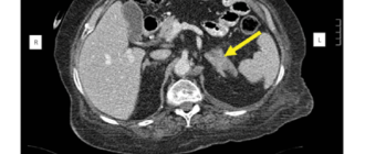 Узловая гиперплазия левого надпочечника