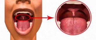 Нарост на небном язычке, фото прилагаю