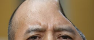 Вмятина в черепе