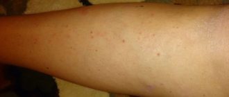 Чешутся икры ног и появляются прыщи