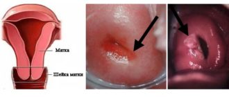 На кокой день вставить свечи после прижигания лейкоплакии