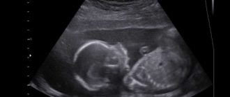 Узи в 21 неделю