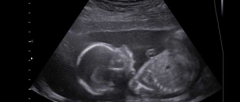 Узи в 21 неделю