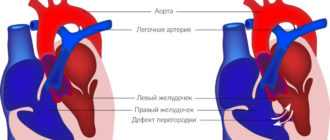 Дмпп новорожденного