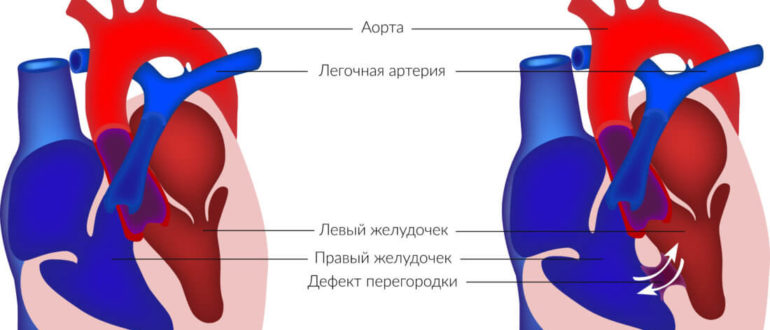 Дмпп новорожденного