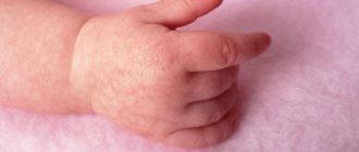 Мраморная кожа