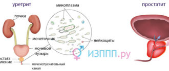 Микоплазма и простатит