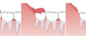 Надрез над зубом мудрости
