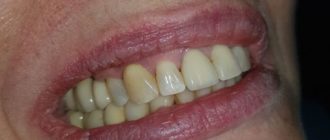 Металлокерамическая коронка на импланте может вызвать аллергию?