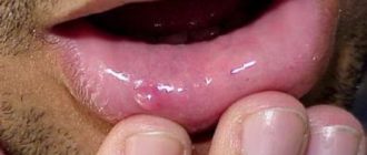 В полости рта пузырьки на щеках