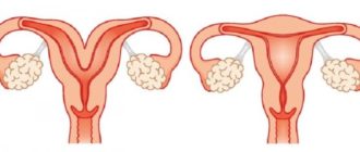 Двурогая матка беременность вторая коричневые выделения беспокоят часто