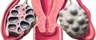 Мультифолликулярный яичник или поликистоз?