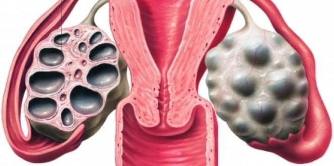 Мультифолликулярный яичник или поликистоз?