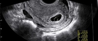 Узи на ранних сроках вред