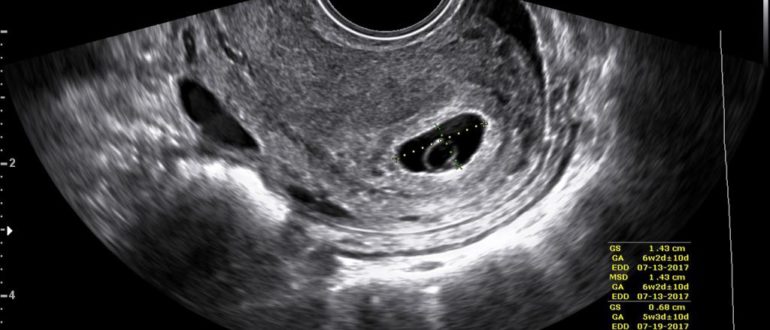 Узи на ранних сроках вред