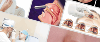 Вазотомия послеоперационный период