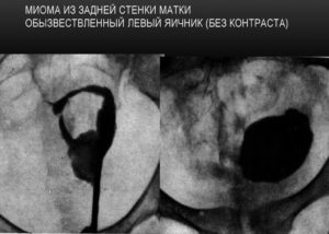 Миома матки на задней стенки матки