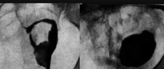 Миома матки на задней стенки матки