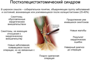 Диарея после приема Клацид СР и постхолецистэктемический синдром