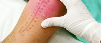 Воспаление после операции