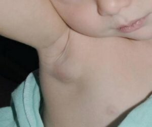 Воспаление подмышечного лимфоузла у ребенка