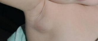 Воспаление подмышечного лимфоузла у ребенка