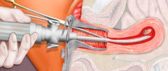Вакуумная аспирация