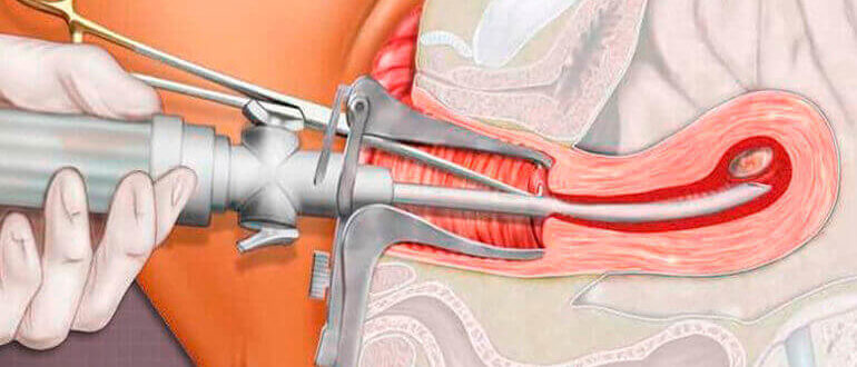 Вакуумная аспирация