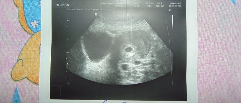 Выделения после узи