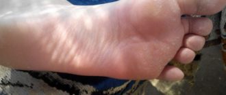 Дырки на ступнях