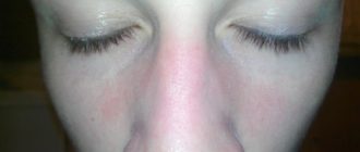 На переносице шелушится пятно