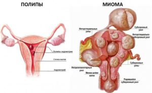 Миома матки и патология эндометрия