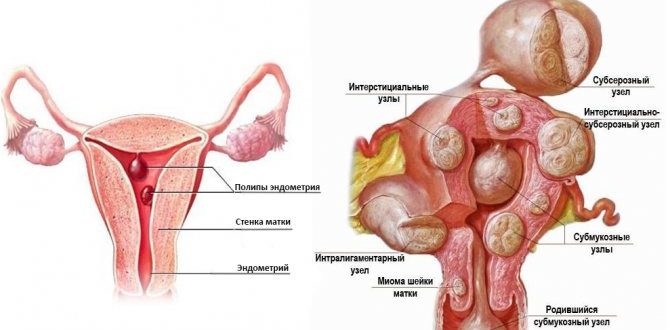 Миома матки и патология эндометрия