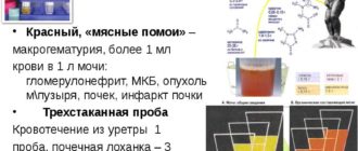 Кровь в моче при МКБ