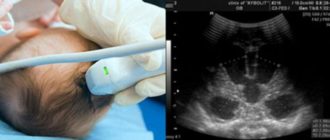 Узи головы ребенка 3 месяца