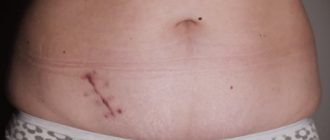 Воспалился шов от удаления аппендицита через 20 лет