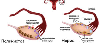 Длинный цикл и очень поздняя овуляция на фоне поликистоза яичников
