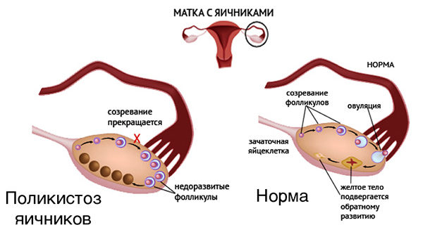 Длинный цикл и очень поздняя овуляция на фоне поликистоза яичников