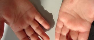 На ладонях и на пальцах рук шипы