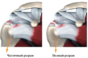 Дегенеративное изменения сухожилия надостной мышцы плеча