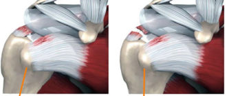 Дегенеративное изменения сухожилия надостной мышцы плеча