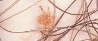 Диагноз педикулёз или нет? На подушке кровавые пятна