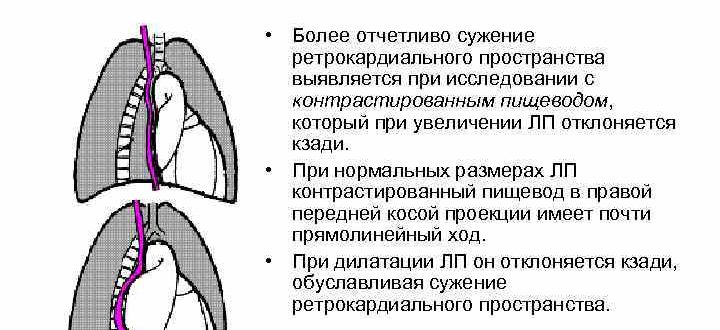 Дилатация ЛП: (