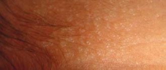 Волдыри в паховой области у ребенка