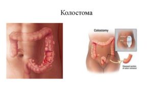 Диарея из толстого кишечника при введении колостомы