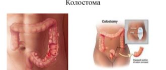 Диарея из толстого кишечника при введении колостомы